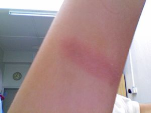 First-degree burn from cooking accident. Pic t...
